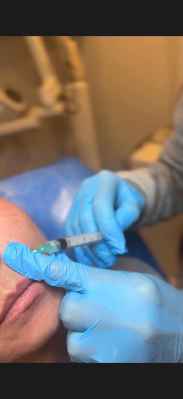 Aplicación de polirevitalizantes inyectables para bioestimulación y rejuvenecimiento cutáneo en Caracas